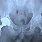 hip-replacement